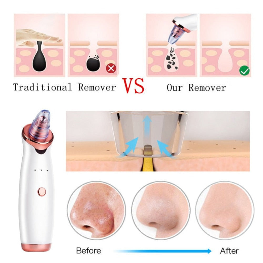 Electric Vacuum Blackhead Remover Device